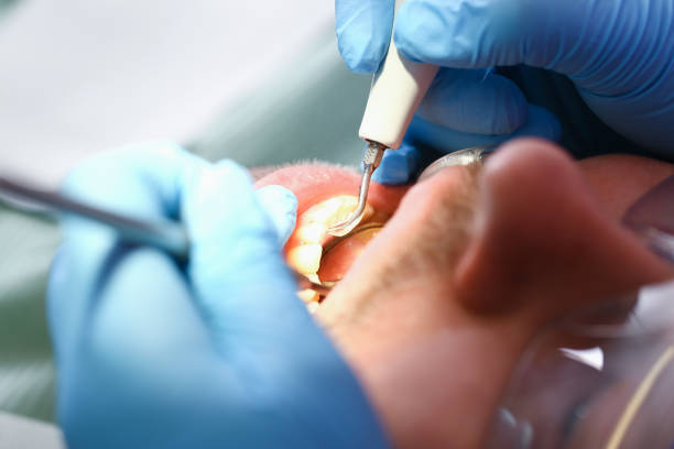Best Broken or Chipped Tooth Repair in Lake San Marcos, CA